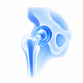 Hip Replacement