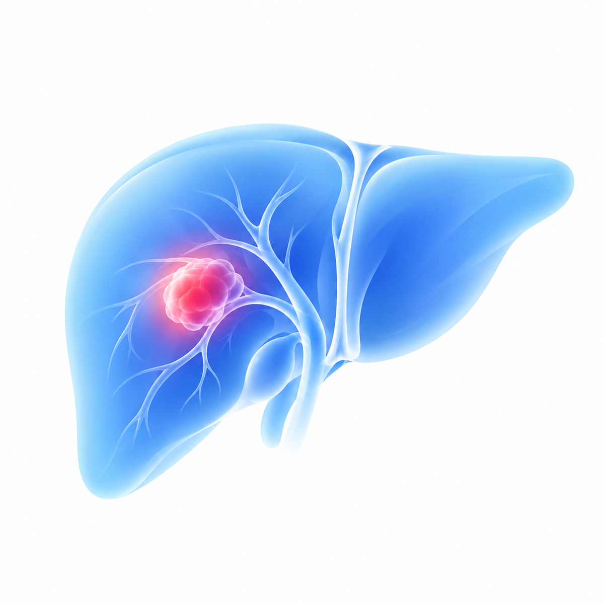 Liver Cancer
