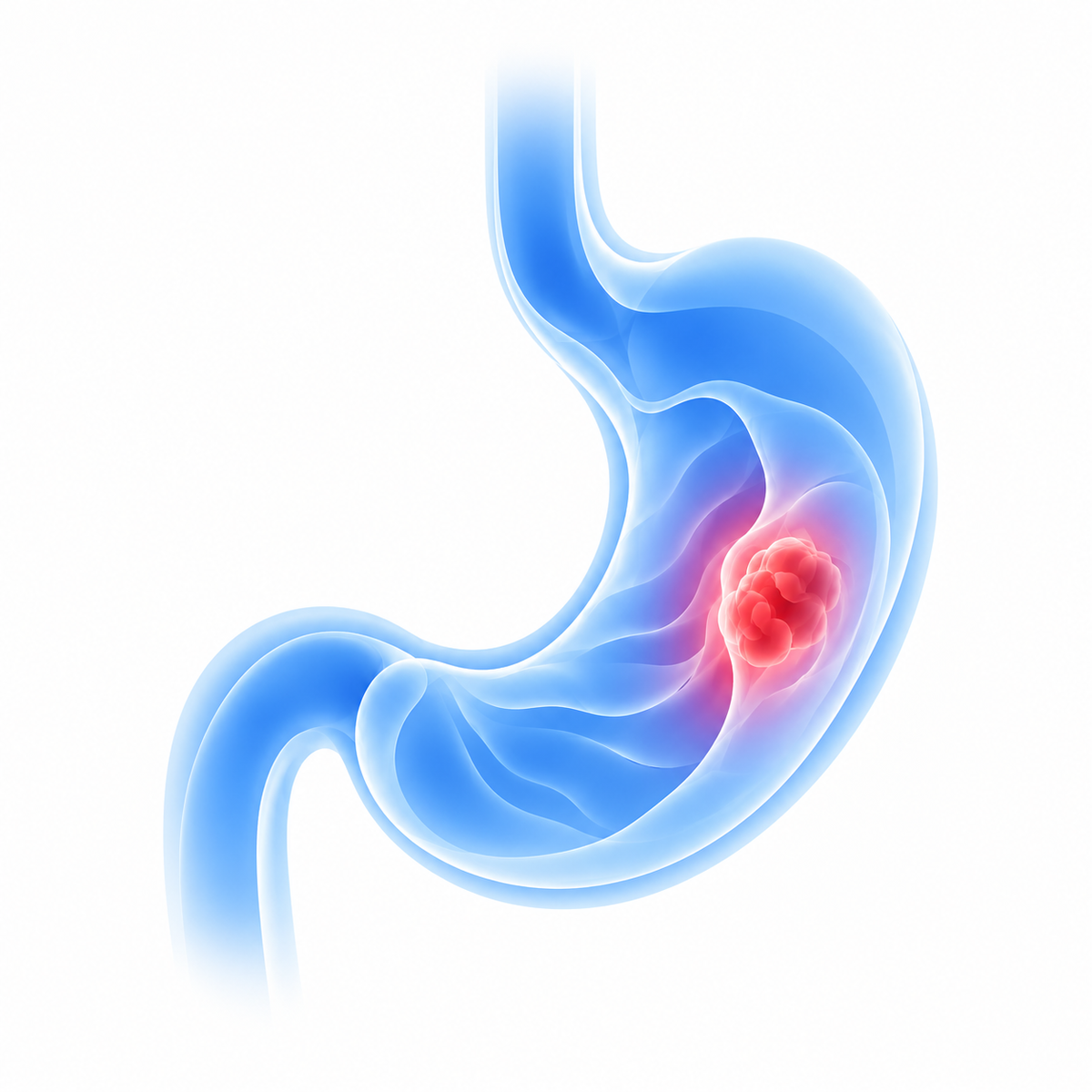 Stomach Cancer