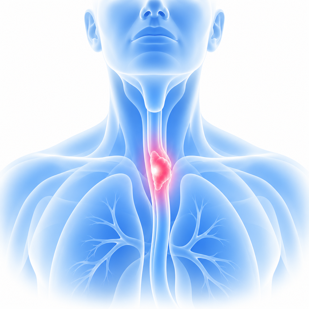 Esophageal Cancer