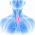 Esophageal Cancer