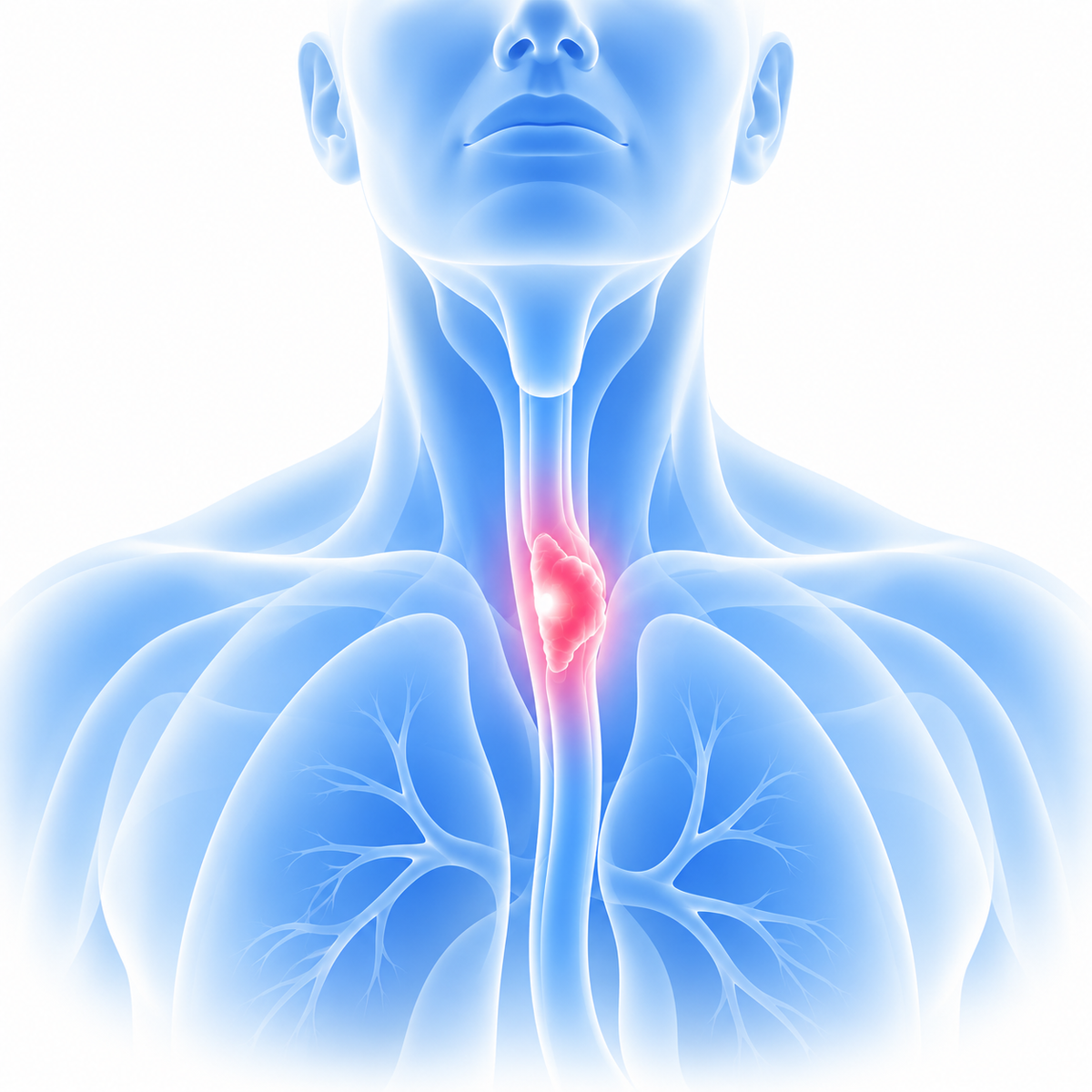 Esophageal Cancer